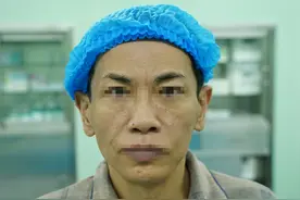 47岁男士拉皮真实记录，术后即刻很“惊艳”图片