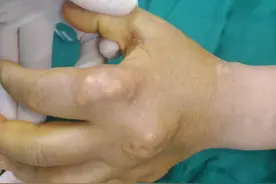 饮食清淡却患上痛风这种“富贵病”，26岁小伙用针挑破痛风石图片