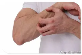 肺癌患者出现皮肤瘙痒意味着病情恶化？中医找准病因一次解决图片