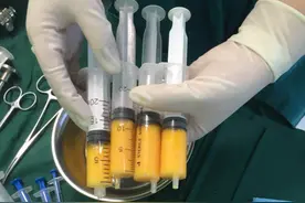 "后悔"做面部脂肪填充，脂肪存活太差了、没效果？图片