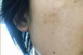 长斑不知怎么办？别急，看完这篇，祛斑还是难事儿？图片