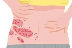 秋季高发，长满一圈“要人命”！发过带状疱疹还需要打疫苗吗？图片