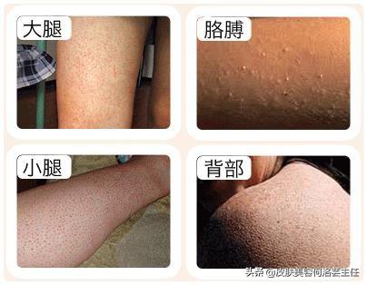 治疗鸡皮疙瘩的方法
