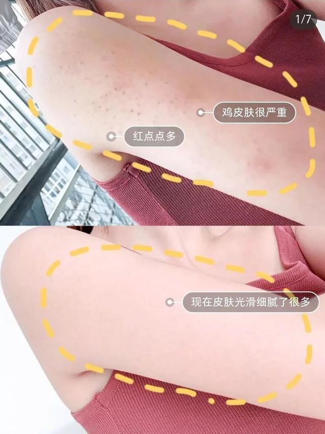 鸡皮肤啥时候能消失