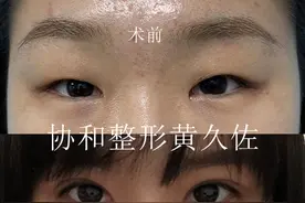 双眼皮、内眼角手术后注意事项图片