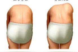 发现孩子先天性脊柱侧凸怎么办？图片