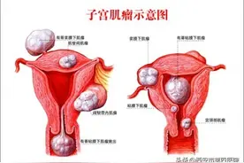 #健康科普汇#【子宫肌瘤患者的饮食注意事项——4】图片