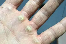 「咬文嚼字」胼胝与胼胝体图片