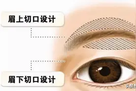 如何判断自己需不需要做切眉术？这三大方面一定要谨记图片