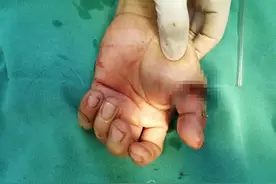 患者不慎斩断手指 市二院创伤外科医生巧手再植助它“复活”图片