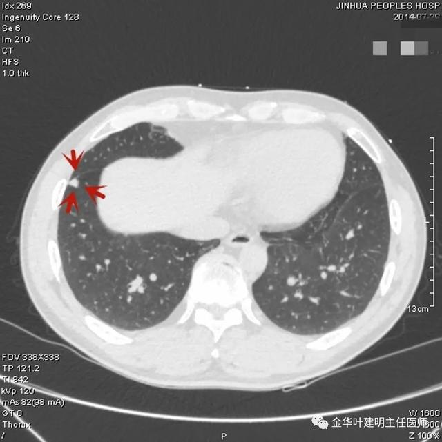 叶建明谈结节：检查发现肺实性结节怎么办？个人版实用指南