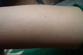 儿童皮肤上出现这些红色皮疹，切莫掉以轻心图片