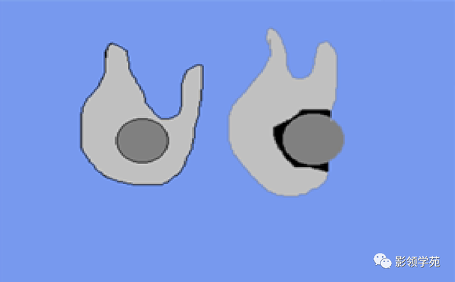 腮腺角化型鳞癌