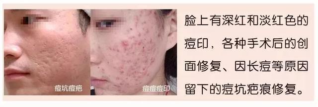 美肌冻干粉有什么作用 美肌冻干粉有什么作用和功效