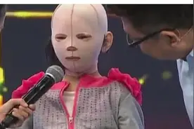 奇闻：6岁孩子被全身烧伤，经过数次整容，摘下头套那刻让人泪目图片