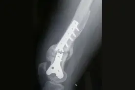 骨折中放的钉子板子，到底需不需要取出来？不取有什么危害？图片