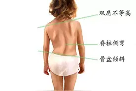 发现自己高低肩，你该怎么办？图片