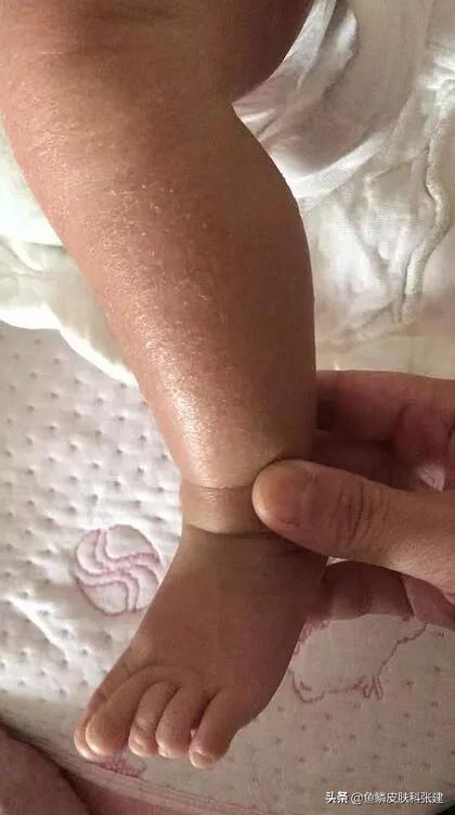毛周角化没有遗传给宝宝的吗