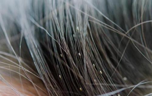 头螨有哪些症状,感染了头螨,头发会出现3个不同的变化,提醒你该除螨了
