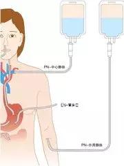 肿瘤、手术患者不可少的肠内营养制剂，到底有多少个种类？