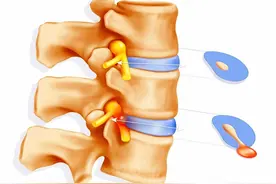 出现腰臀部的疼痛，是腰椎间盘突出引起的吗？您可以好好看看此文图片
