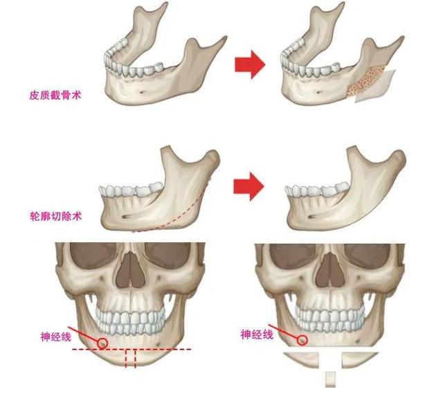 想磨骨改脸型,你最好先了解这些知识