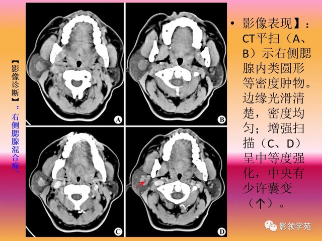 腮腺角化型鳞癌