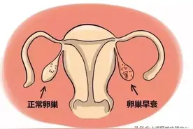 卵巢早衰可以做试管婴儿吗？成功率高不高？图片