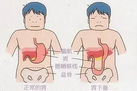 年纪轻轻就胃下垂，这六个方法可改善图片
