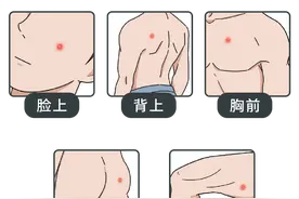 女性的“尴尬部位”长痘痘？不同部位的痘痘，暗示不同的身体问题图片