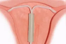 适合哪种节育环医生告诉你图片