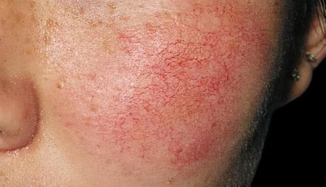 脸上的红血丝怎么消除？脸上为什么会有红血丝？