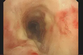 腿上有红斑，15岁姑娘疏忽身体发出的求救信号，6年后一发病就不能说话图片