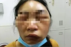 又来了！女子早上醒来全脸发肿，紧急提醒：严重可致命图片