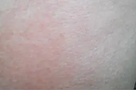 身体瘙痒，挠一挠就没事了，医生：可能是这三种大病图片