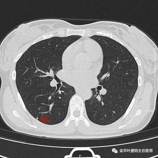 叶建明谈结节：检查发现肺实性结节怎么办？个人版实用指南