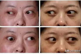 眼睛太突出？你可能犯了甲状腺相关性眼病图片