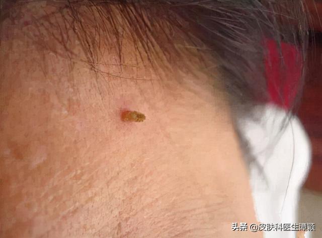 毛周角化和丝状疣的区别