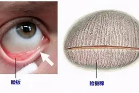 眼睛里长出了巨大的“结石”。医生提醒：眼睛不舒服要及早就医图片