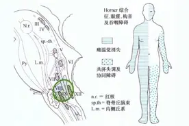 巧记Wallenberg综合征图片