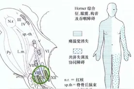 巧记Wallenberg综合征图片
