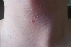 脖子和胳肢窝下的“肉粒”是啥？对身体有什么影响？建议别忽视图片