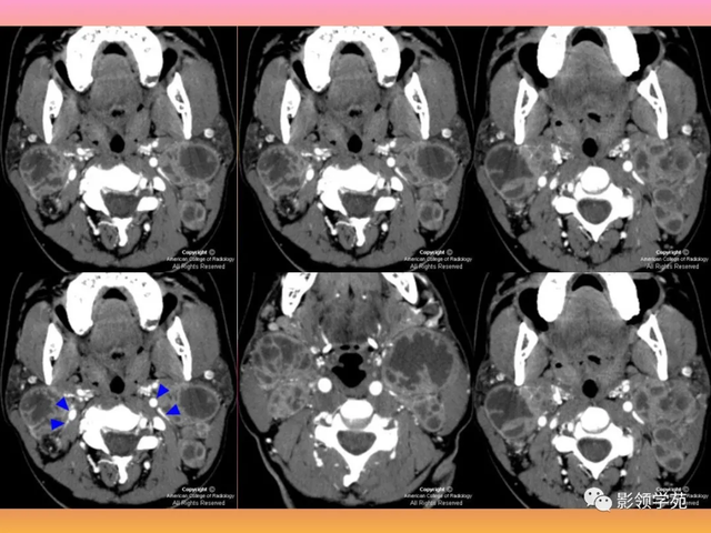 腮腺角化型鳞癌