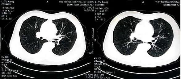 中央型肺癌非角化