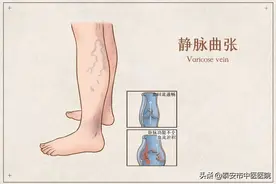 告别"蚯蚓腿"完美入夏天——介入微创帮您轻松解决下肢静脉曲张图片