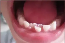 孩子新牙萌出，老牙却不舍得离开？图片