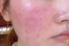 睡前坚持2不做，早晨坚持做3件事，敏感肌一个月告别敏感泛红图片