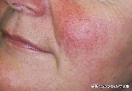 毛周角化症用酮康唑可以吗
