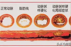 动脉硬化≠动脉粥样硬化，学好软化血管的3步骤，血流通畅少堵塞图片