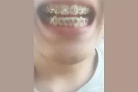 正畸前需要做哪些准备？图片